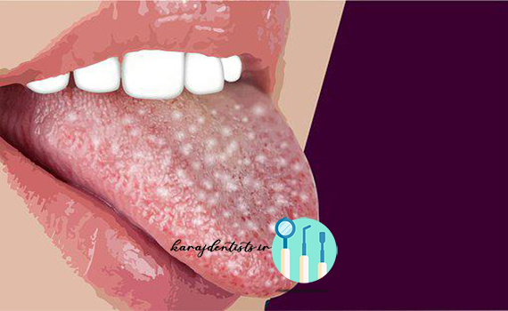 خونریزی زبان نشانه چیست
