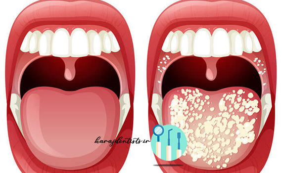 عفونت های دهان