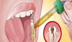 درمان دندان‌درد با سرم فیزیولوژی دندان