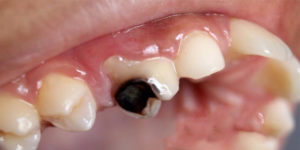 عوامل بروز دندان‌درد