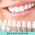 قیمت لمینت دندان در کرج