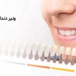 ونیر دندان