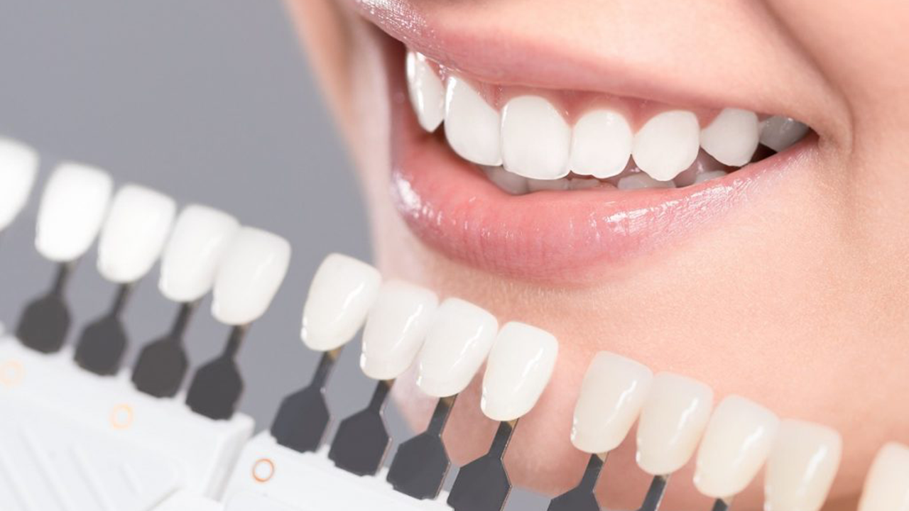 فرق کامپوزیت ونیر با لمینت چیست؟ - karajdentists | فرق کامپوزیت ونیر با  لمینت دندان