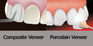 فرق کامپوزیت ونیر با لمینت