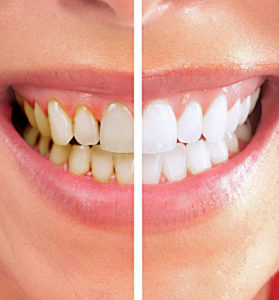 بلیچینگ دندان چیست