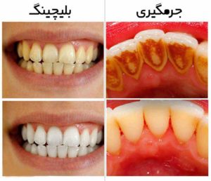 پک بلیچینگ دندان-2