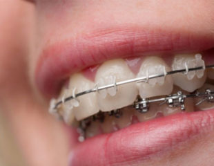 بلیچینگ دندان بعد از ارتودنسی-1