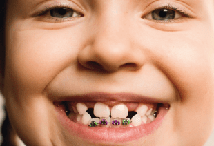 دندانپزشکی کودکان-1