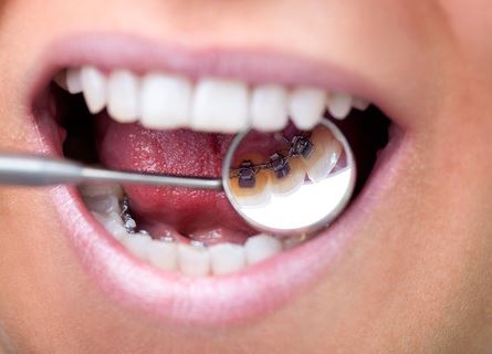 روش های ترمیم و زیبایی دندان-1