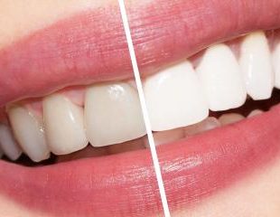 بلیچینگ دندان بهتر است یا کامپوزیت-1