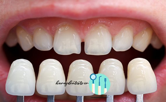 ونیر دندان و متخصص ترمیم و زیبایی دندان