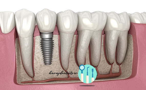 ایمپلنت دندان