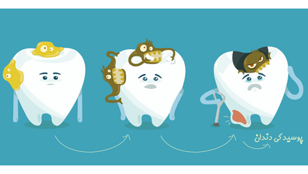 عوامل تشدید کننده پوسیدگی دندان