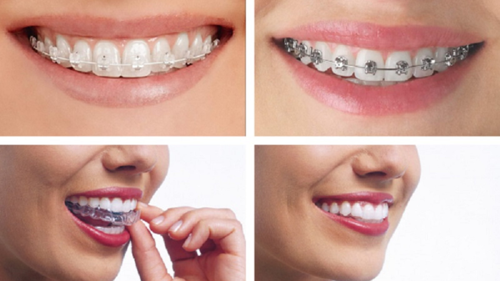 انواع درمان ارتودنسی دندان