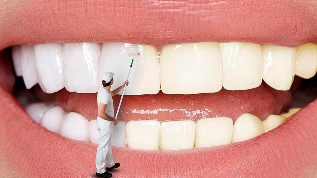 بلیچینگ دندان با بیمه