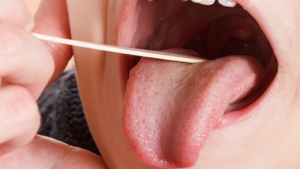 درمان خشکی دهان