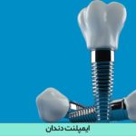 ایمپلنت دندان