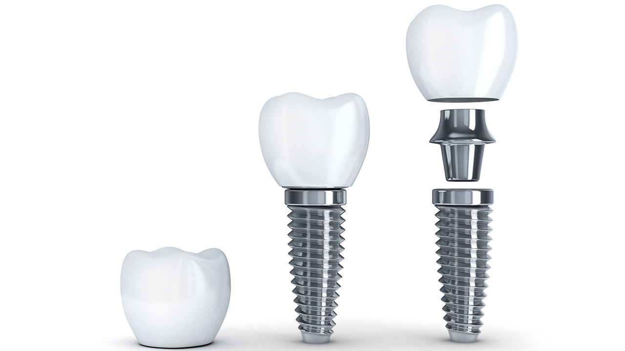 مراحل انجام ایمپلنت دندان
