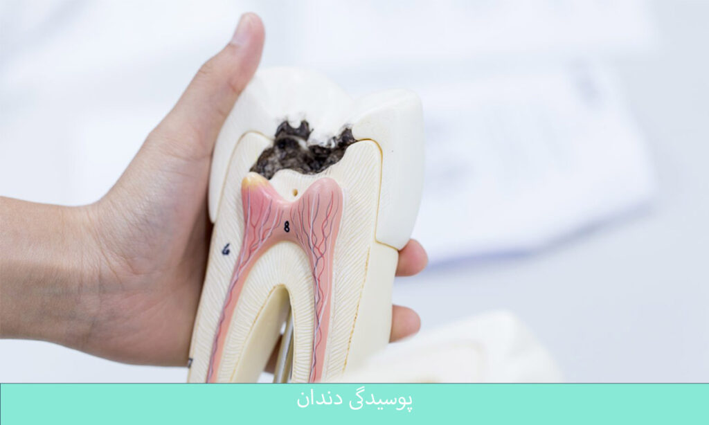 پوسیدگی دندان چیست