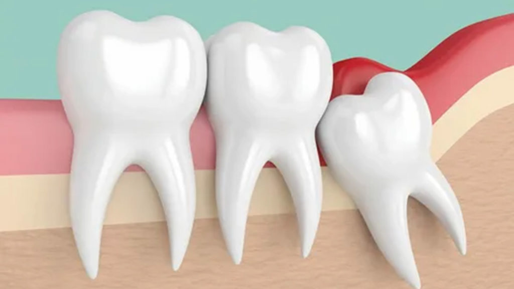 مشکلات دندان عقل