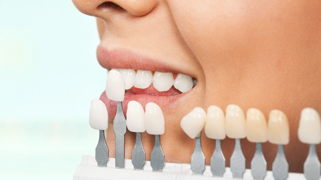عوامل وابسته به ماندگاری لمینت دندان