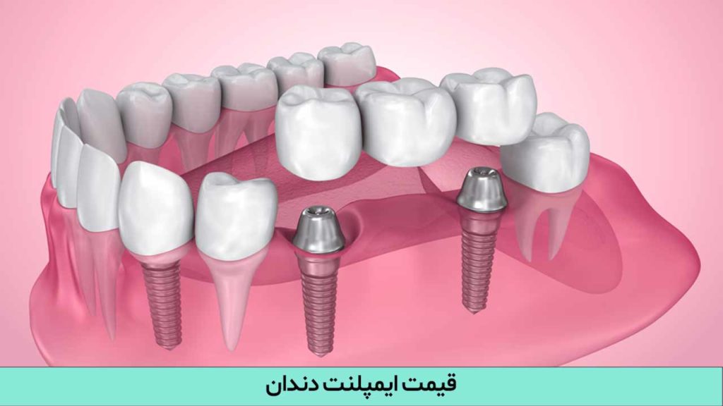 قیمت ایمپلنت دندان در سال 1402