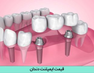 قیمت ایمپلنت دندان در سال 1402