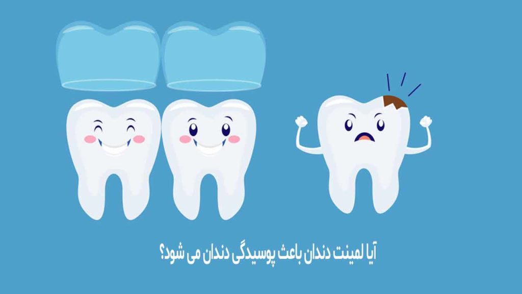 آیا لمینت دندان باعث پوسیدگی دندان می شود؟