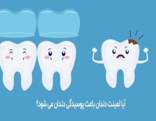 آیا لمینت دندان باعث پوسیدگی دندان می شود؟