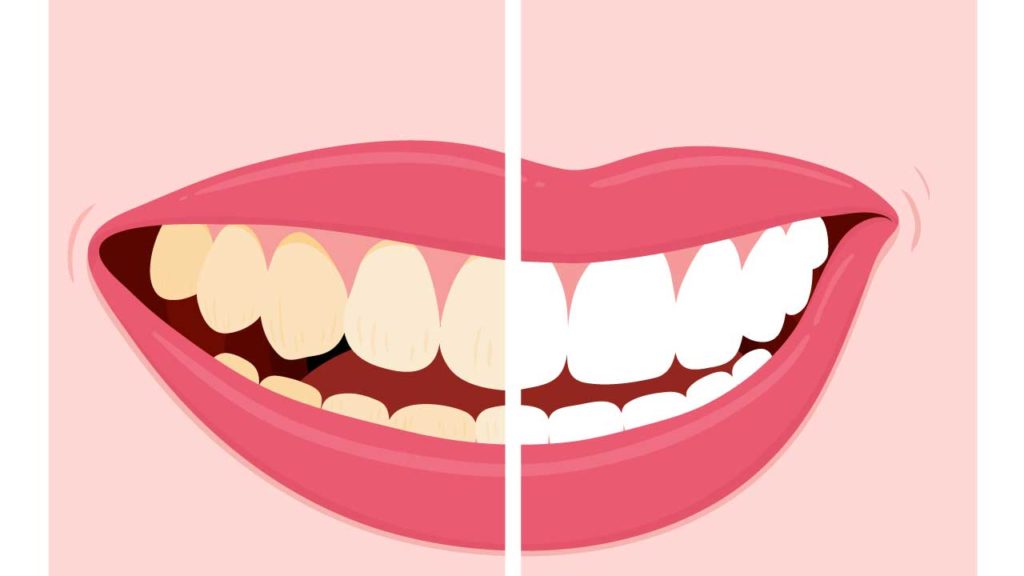 آیا بلیچینگ دندان ضرر دارد؟