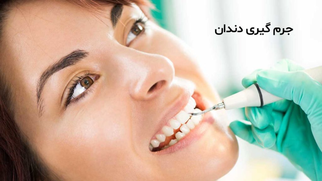 جرم گیری دندان