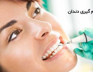 جرم گیری دندان