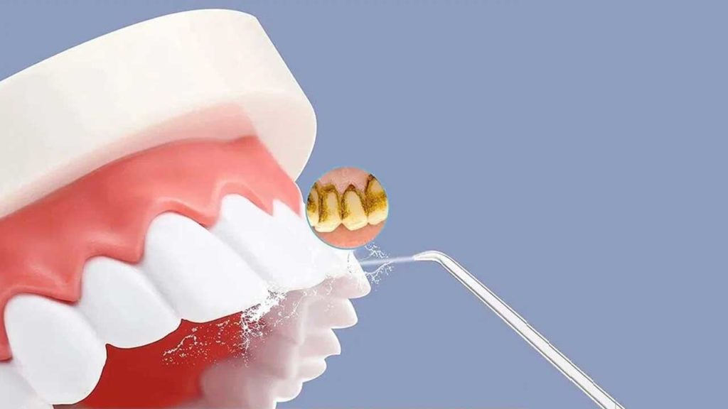 عوارض جرم گیری دندان