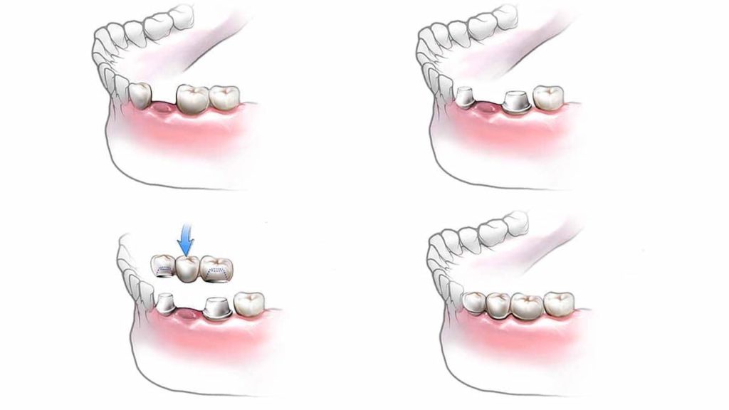 نحوه نصب پل دندانی چیست