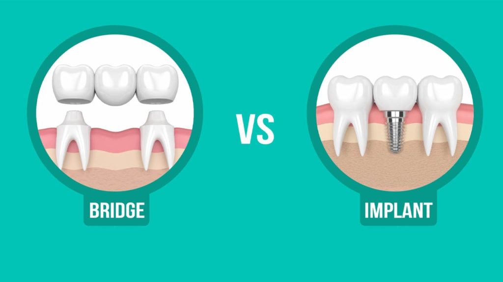 پل دندان بهتر است یا ایمپلنت
