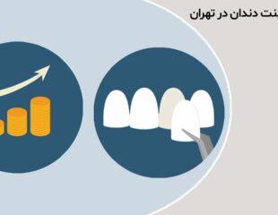 قیمت لمینت دندان در تهران