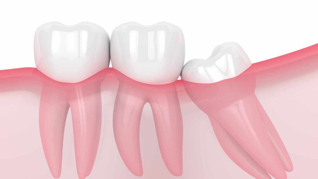 دندان عقل چیست؟