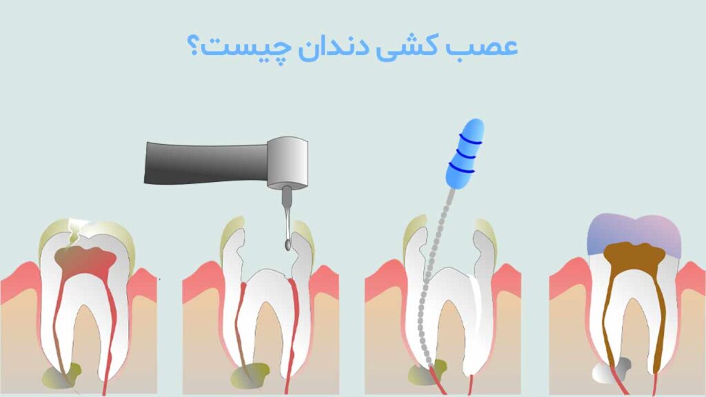 عصب کشی دندان چیست؟