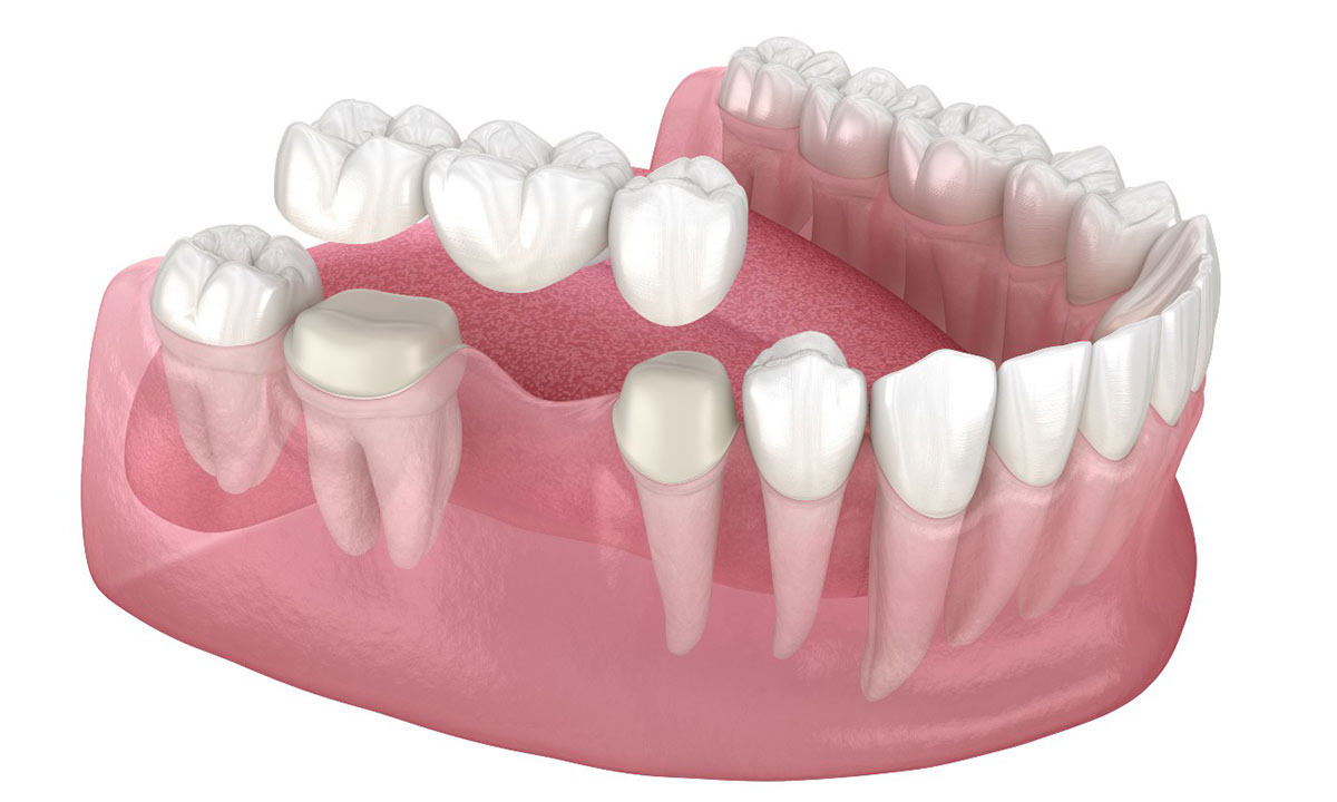 پل دندانپزشکی سنتی