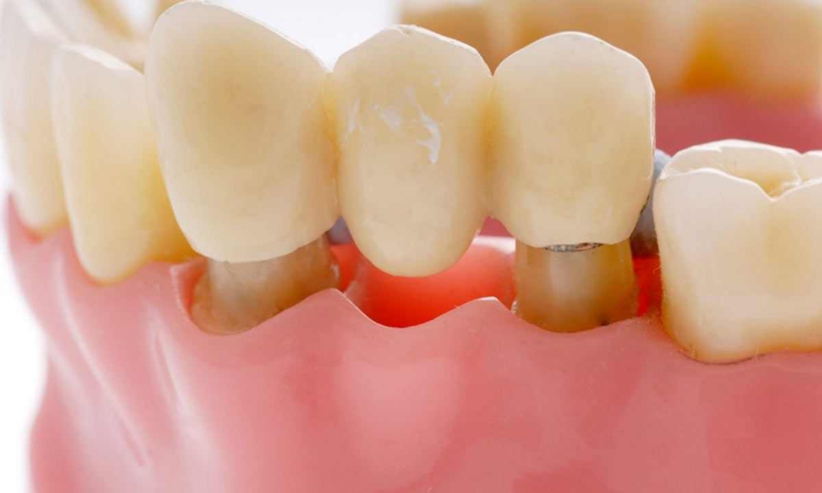 معایب بریج دندان به علت تراش دادن دندانهای کناری