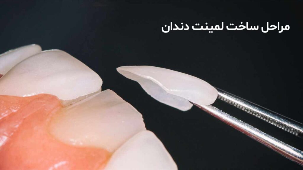 مراحل ساخت لمینت دندان