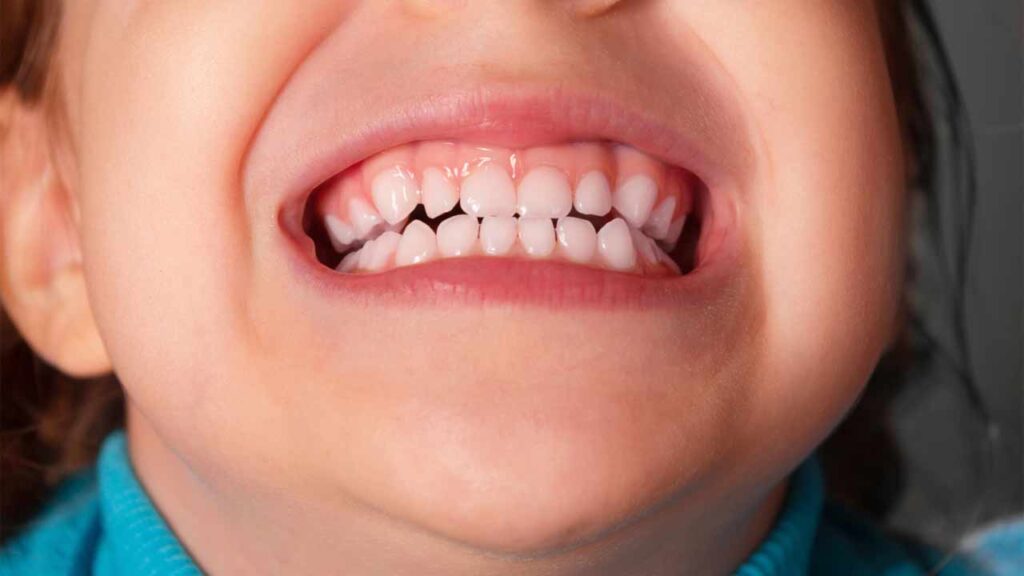 دندان قروچه در کودکان
