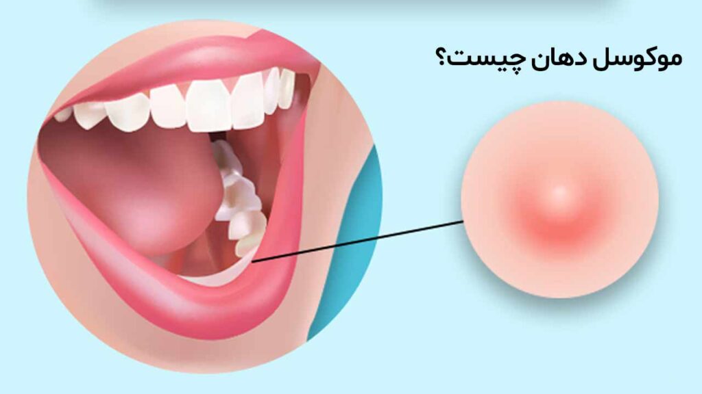 موکوسل دهان چیست؟