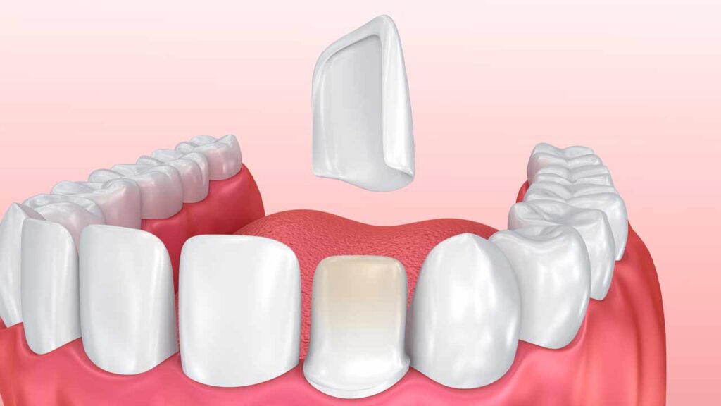 عوارض کامپوزیت دندان