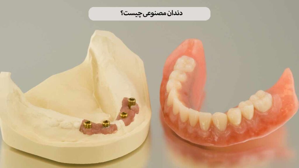 دندان مصنوعی چیست؟