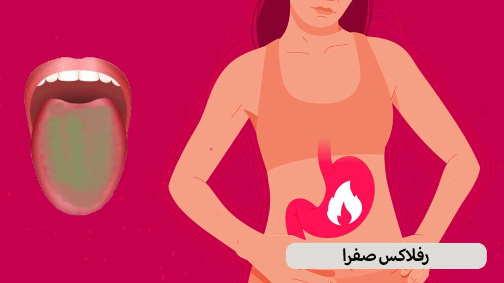 رفلاکس صفرا