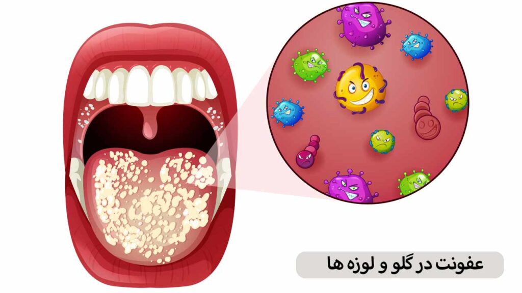 عفونت در گلو و لوزه ها