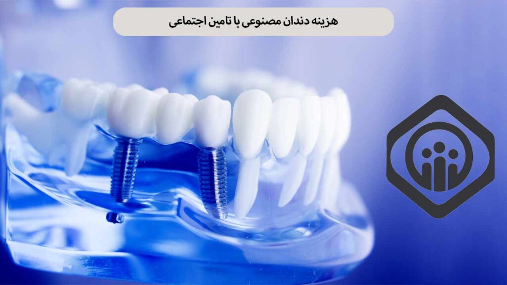 هزینه دندان مصنوعی با تامین اجتماعی